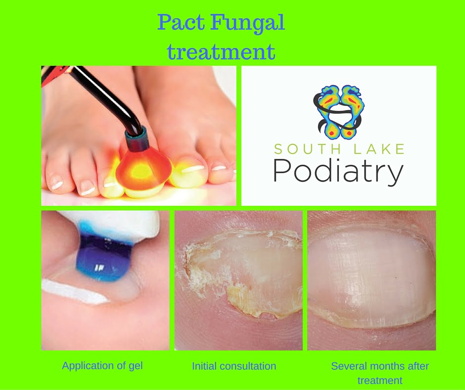Pact_Fungal_treatment